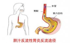 检查胆汁反流性胃炎方法有哪些