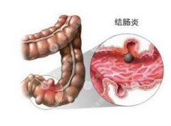 患了结肠炎什么东西不能吃？