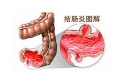 <b>结肠炎有哪些症状？</b>
