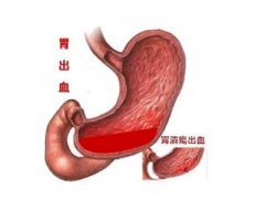导致胃出血的原因有哪些?