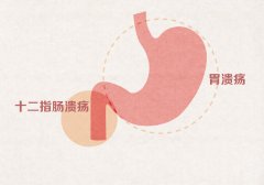 胃溃疡常见的并发症有那些？