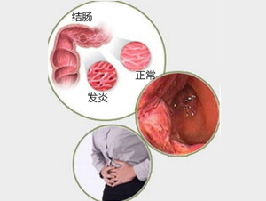 肠炎会对患者带来哪些危害?