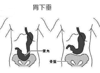 胃下垂发病原因