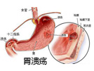 胃溃疡的严重危害及治疗