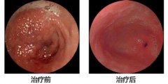 糜烂性胃炎治疗多少钱