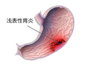 慢性浅表性胃炎的检查