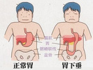 胃下垂会给患者带来哪些危害