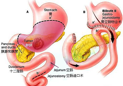 十二指肠溃疡有哪些表现 ?