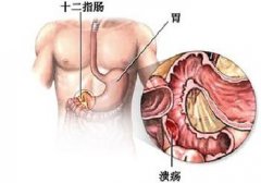 十二指肠溃疡需要做哪些检查呢