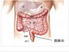 慢性肠炎有哪些危害?