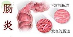 引发直肠炎的因素是什么