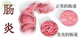 直肠炎的原因有哪些