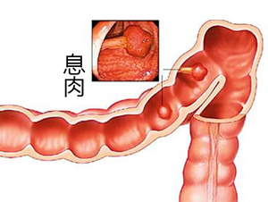 肠息肉患者的家庭护理要注意哪些