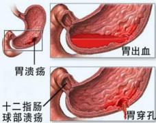 胃出血应该怎么检查？
