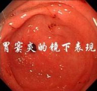 <b>胃窦炎的发病主要有哪些原因？</b>
