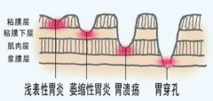 浅表性胃炎危害到底有多大？
