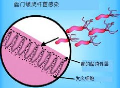 幽门螺旋杆菌呈阳性该怎么治疗