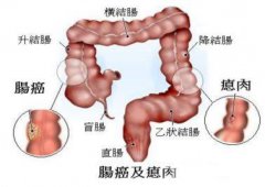 结肠息肉有可能发生*变？