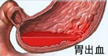<b>引发胃出血的原因有三种</b>