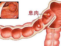 得了肠息肉怎么办？肠息肉的危害有多大？
