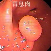 胃息肉到底要不要切除？胃息肉有什么危害？