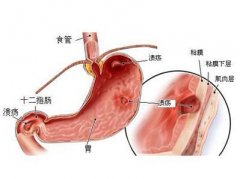 胃溃疡病人的饮食宜忌