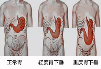 怎么检查是否患有胃下垂？
